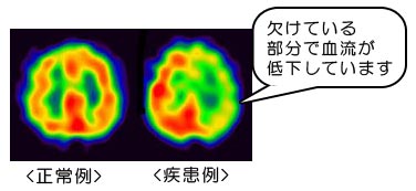 脳血流シンチグラフィー