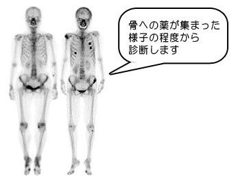 骨シンチグラフィー